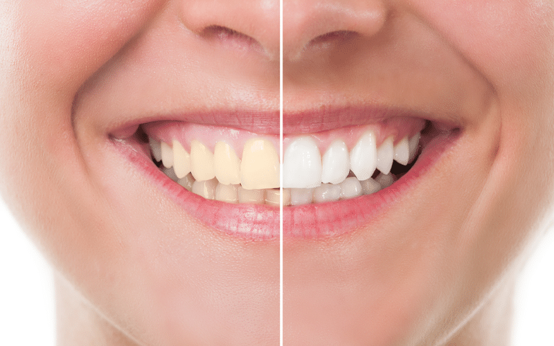 Teeth-Whitening-Rect
